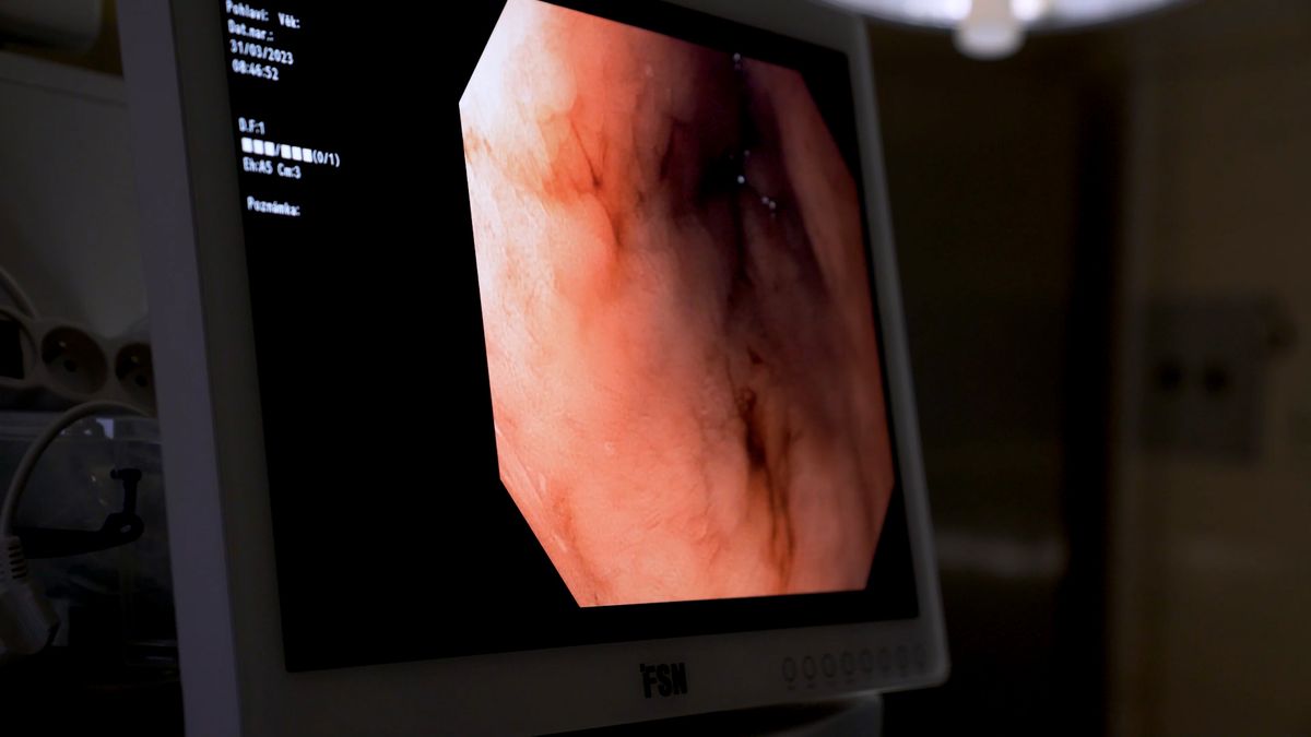 Časné nádory střeva lze nově v motolské nemocnici vyndat bez nutnosti operace
